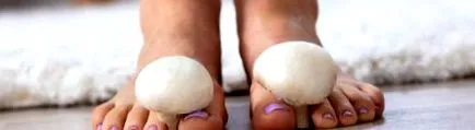 candidiasis