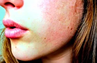 dermatitist