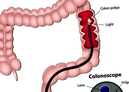colonoscopie este