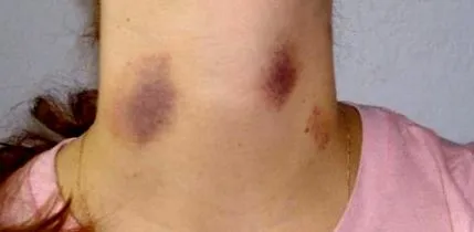 hickey-t