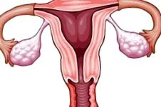 fibroid myomectomia