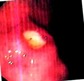 gastric