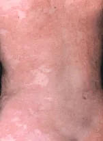 tratamentul
