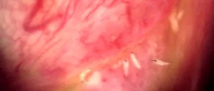 myiasis