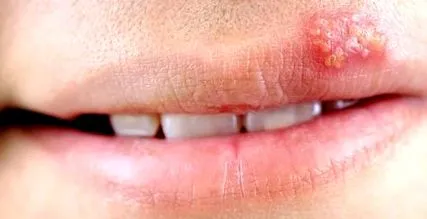 herpes