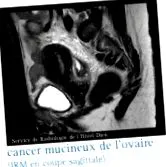 rákok infocancer