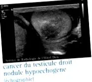 infocancer