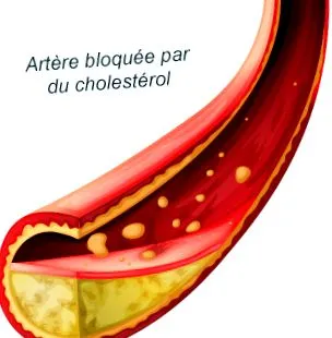 trigliceridek feleslege