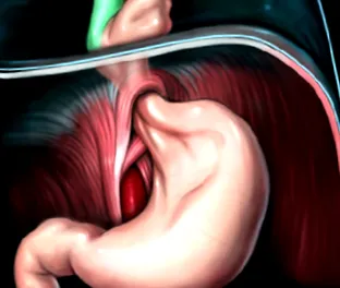 gastrooesophagealis
