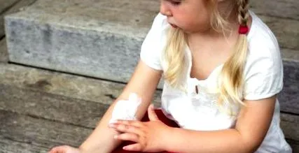 ekcéma