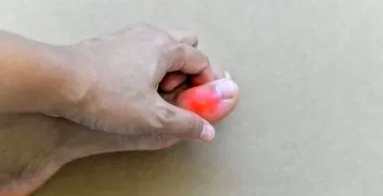 guta