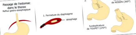 reflux