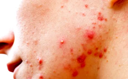 acneea
