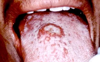 szájüregi candidiasis szájüregi
