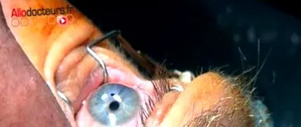 keratoconus