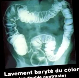 crohn-betegség