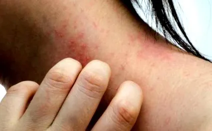 dermatitis dermatitis