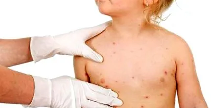 dermatitis
