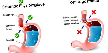 gyomor-nyelőcső reflux