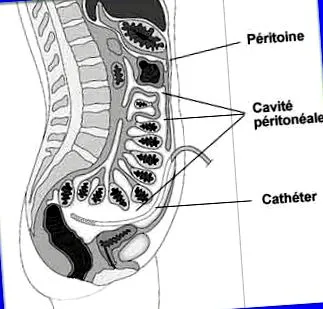 peritonealis dialízis