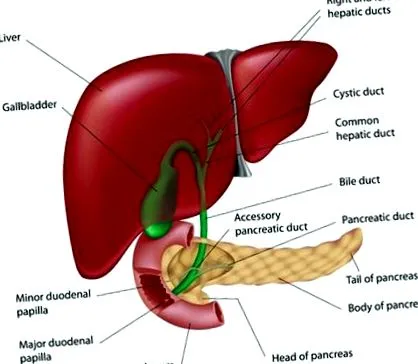 lithiasis