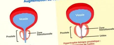prostatei