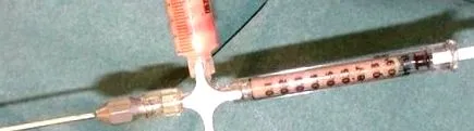 lipofilling altoire