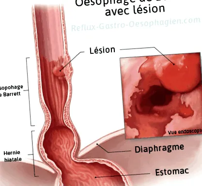 reflux
