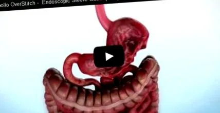 gastroplastia