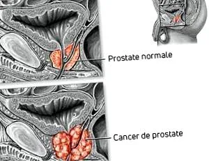prevenirea