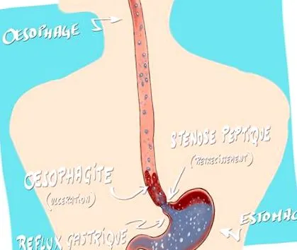 reflux