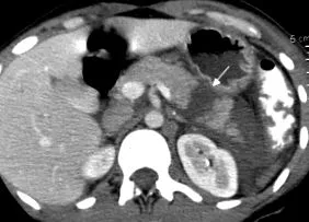 abdominală