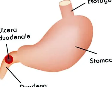 duodenitis
