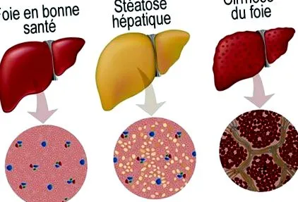 hepatică