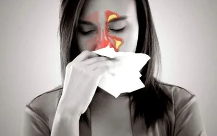 sinusitis