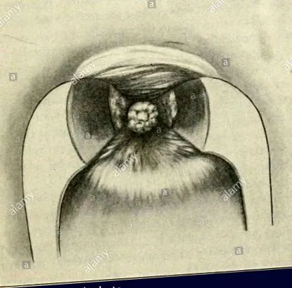 kismedencei
