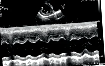 cardiomiopatie