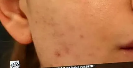 tratarea