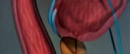 cancerul tratamente