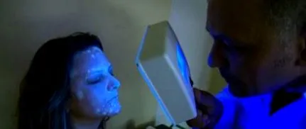 vitiligo