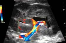 echodoppler