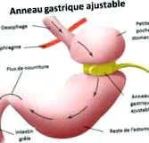 gastric