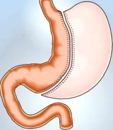 gastrectomie