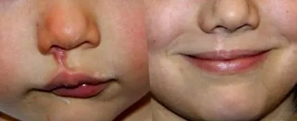 cicatricială cicatricială