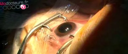 cataracta