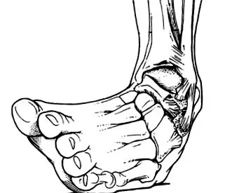 entorsa