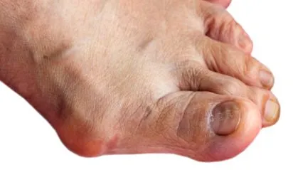 bunion hallux