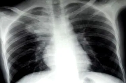 tuberculozei