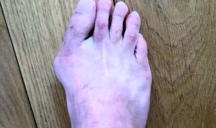 hallux
