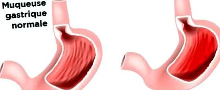 ulcer